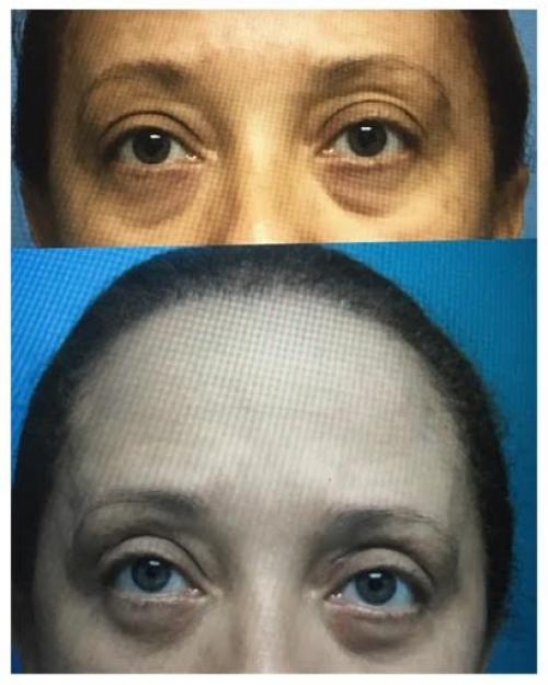 blefaroplastia