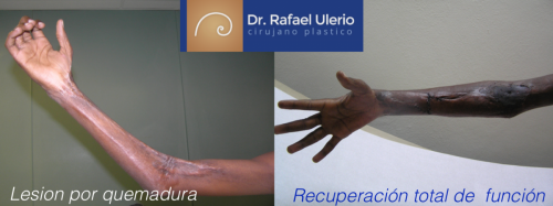 1f quemadura 
