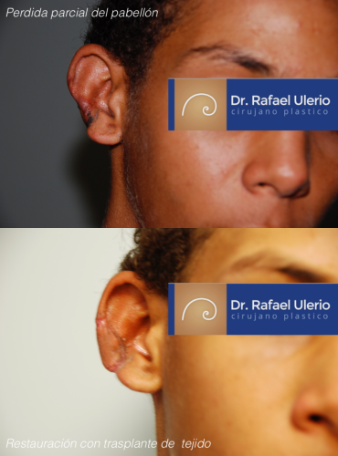 1g Reconstructiva 